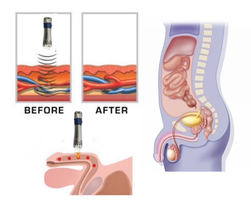 5-200 Mj Muscle Relaxer Machine , Shockwave Therapy Device For Pain Relief
