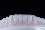 Long Lasting Dental Composite Veneer Good Biocompatibility No Drop Off porcelain