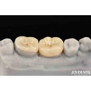 Emax Inlay Onlay Precise Fit And Hypoallergenic Biocompatibility Easy To Clean