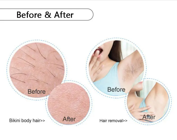 Laser Type Diode Laser Hair Removal Machine with 15*15mm Spot Size