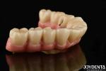 Aesthetic Titanium Malong Hybrid Dental Implant Bridge For Dental Perfection