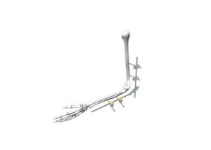 China Safety External Fixation System Dissection IV Φ5- Children’S Elbow Fixation factory