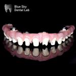 Customizable Pure Titanium Malo Bridge Dental Blue Sky Implant System
