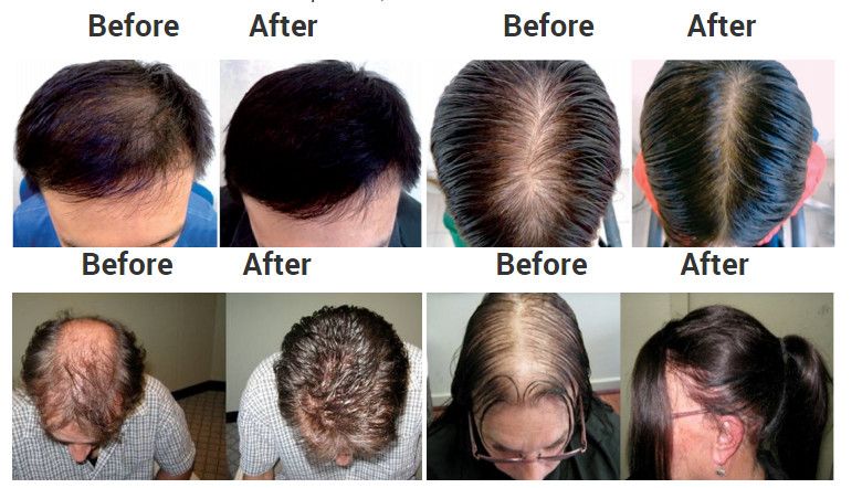 Laser Light Treatment Laser Cap for Hair Loss and Hair Regrowth