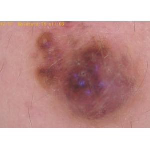 Skin and Scalp Detector Video Dermatoscope with Analysisi Report of Moisture Oil