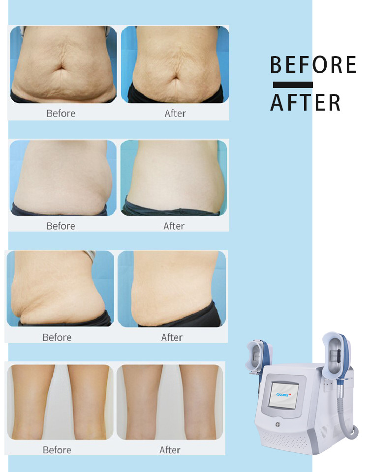 2021 NEW design popular wholesale cellulite removal fat reduce cryo machine 360 cryo machine for sale