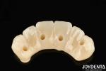 Dental Restoration Ti-Base Zirconia Hybrid Bridge Natural Looking Precise Fit