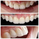 Anterior Tooth Indication Dental Veneers With 0.5mm Thickness And Perfect