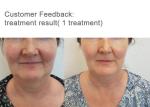 Fda Approval 5D ICE Ultrasonic Hifu For Skin Tightening