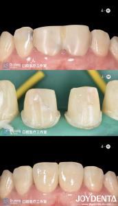China Perfectly Fit teeth Zirconia Dental Crowns With CAD CAM Systems For Precision Manufacturing factory