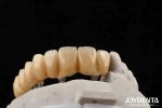 Close Friends Of Bones Foundation Of Beauty Zirconia Implants Aesthetically