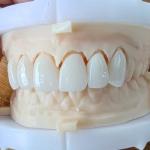 Natural Esthetics Layered Zirconia Crown Bridge For Beautiful Smile And Good