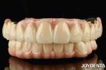 Excellent Strength Ti-Bar Zirconia Hybrid Bridge For Natural Teeth And Gums