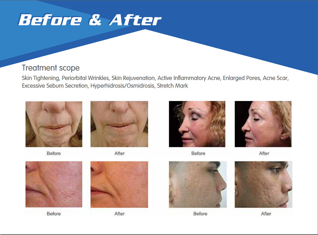 Skin maintenance micro needle nurse system secret microneedle fractional intracel rf micro needling