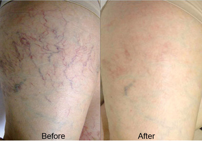 CW Thread Vein Removal Machine Berylas Minimally Invasive Laser