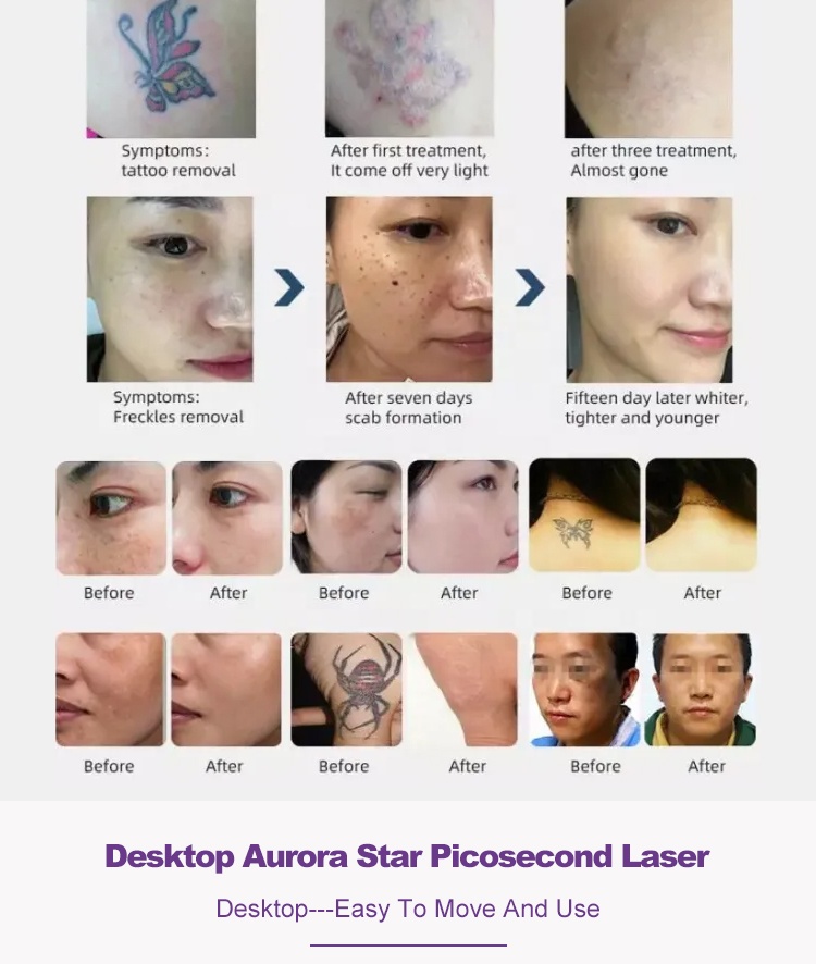 Laser Beauty Equipment Professional Pico Picosecond Machine Q Switched Nd Yag Laser Tattoo Removal Machine