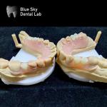 Resin Valplast Flexible Partial Dentures Before And After Valplast Partial