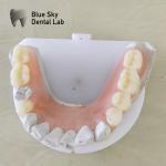 Natural Smile Dental Valplast Dentures Flexi Valplast Removable Partial Denture