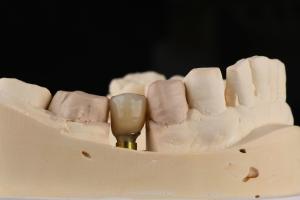 China Sandblasted Single Tooth Implant With Self Tapping Thread And Internal Hex Connection factory