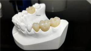 China Ceramic Dental Crown,Zirconia Dental Crowns factory