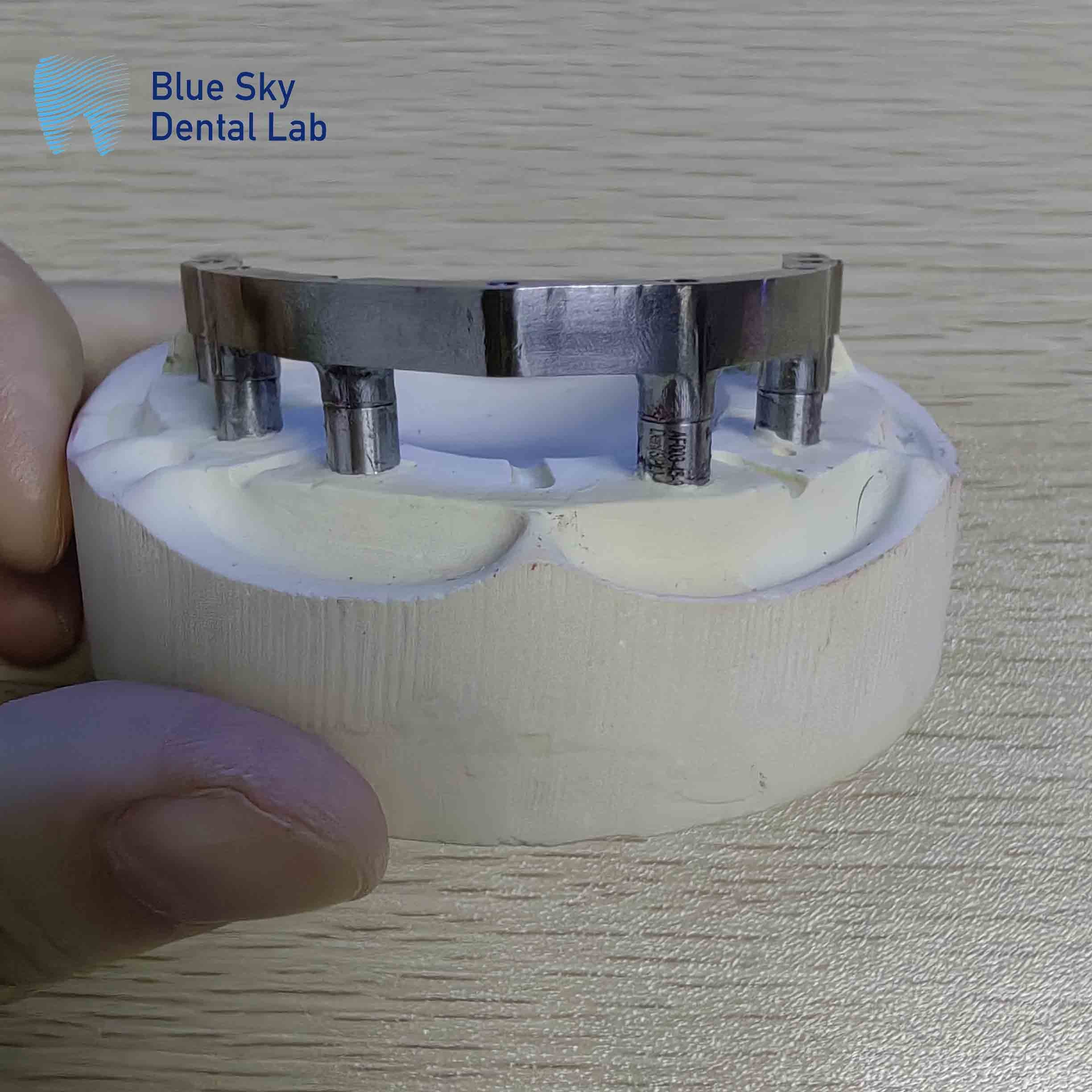 Full Mouth Milled Titanium Bar Dental Locator Denture Attachments