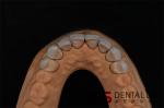 High Stain Resistance Dental Emax Ceramic Veneers Crown For Teeth 400MPa