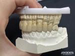Seamless PFM Porcelain Fused Metal Crown For Long Term Biocompatible Restoration