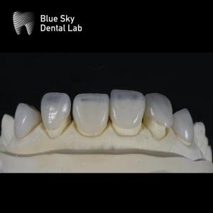 China Ultra Thin Sleek Veneer Cases 0.3mm Thinnest Custom Veneers factory