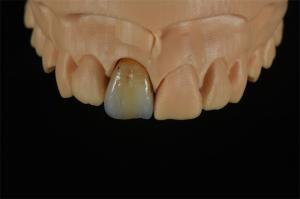 China Affordable Zirconia Crowns with Custom Color Staining - China Dental Lab factory