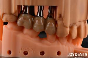 China High Flexural Strength Multilayer Full Zirconia Dental Solution Full Arch Restorations factory