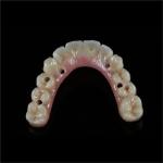 ODM Full Arch Zirconia Implants Bridge Zirconium Implants Holistic Dentistry