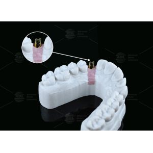 Internal Hex Custom Titanium Abutment Screw Cement Retained Varying Shape
