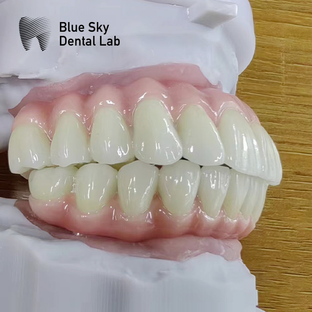Blue Sky Implant Cases With Malo Frame Bridge Pure Titanium