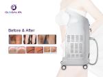 High Efficiency Diode Laser Hair Removal Machine 808 Laser Hair Removal Device
