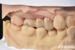 High Biocompatibility Zirconia Full Contour Crown Perfect Fit High Strength