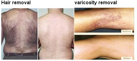 Long Hair Removal NG ND YAG Laser Pulse with Width 10 / 20 / 30 / 40ms