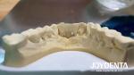 Customizable Dental Maryland Resin Bonded Bridges for Anterior And Premolar