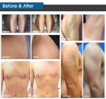 Ice Titanium Laser Hair Removal Device IPL OPT 808nm Diode Laser Hair Removal