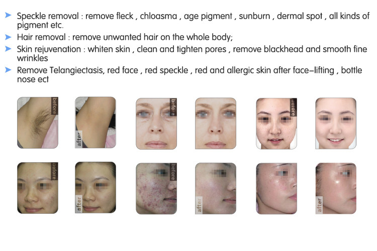 （SHR+E-light+IPL，three technologies in one）SHR Hair Removal ,skin rejuvenation Machine