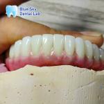 Universal Compatibility Implant Cases Customize Full Mouth Implant Case