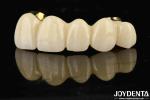 Excellent Strength Ti-Bar Zirconia Hybrid Bridge For Natural Teeth And Gums