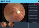 Software of Report Available Digital Fundus Camera Telemedicine Ophthalmic
