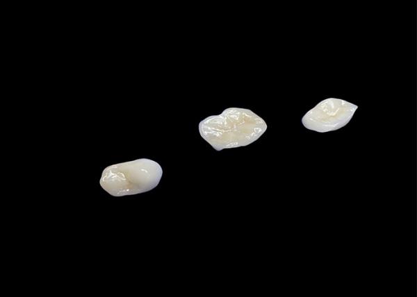 Biocompatible Ceramic Inlays and Onlays Designed for Comfort Durability and