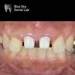 Layered Zirconia Implant Crown Zirconia Abutment Biocompatible