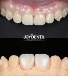 Lightweight Smooth Surface Zirconia Dental Bridges For Implant Supported