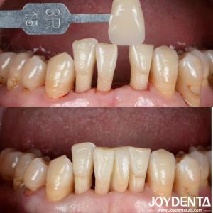 China Natural Shape Ceramic Maryland Bonded Bridge Dental Restorations Excellent Aesthetics factory