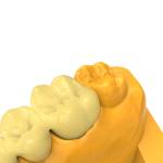 Odorless Composition Of Permanent Crown Bridge Resin For Pleasant Experience