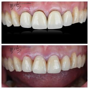 China Comfortable Zirconia Dental Bridges Lightweight Natural Color Transitions For Optimal Patient Experience factory