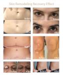 Semi Permanent Pmu Pigment Ink White Freckles Vitiligo Skin Remodeling