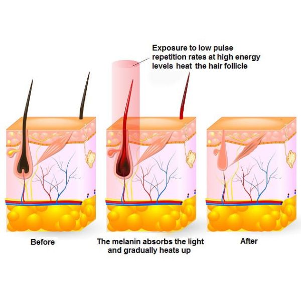 mixed diode laser yag laser